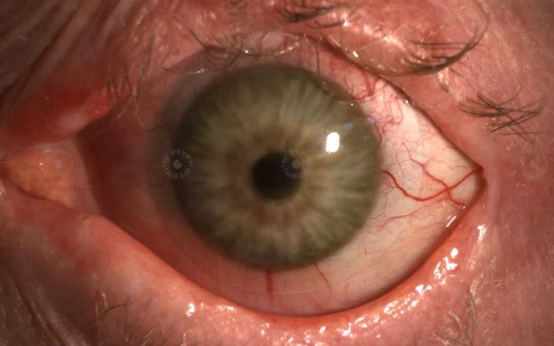 Handgezeichnete Iris-Linse